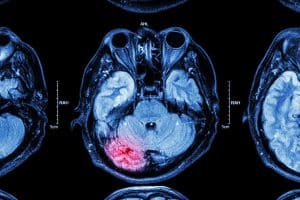 What Is a Diffuse Axonal Brain Injury?